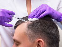 השתלת שיער – שיטת FUE: טכניקת השתלת שיער ללא גילוח