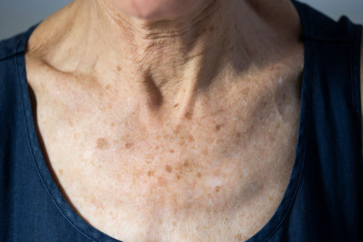 אסתטיקה למחשוף הנשי: הכירי את הטיפולים הייעודיים לאזור הדקולטה