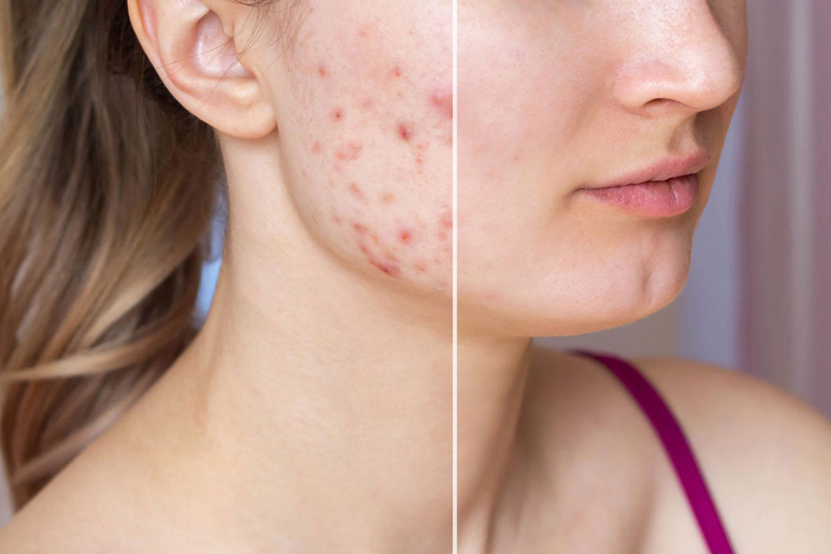 טיפול באקנה - כל מה שרציתם לדעת