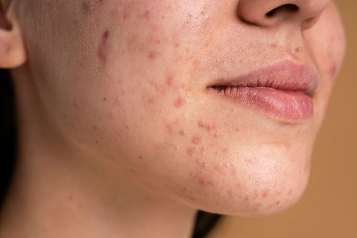 טיפול באקנה: כל מה שאתם צריך לדעת