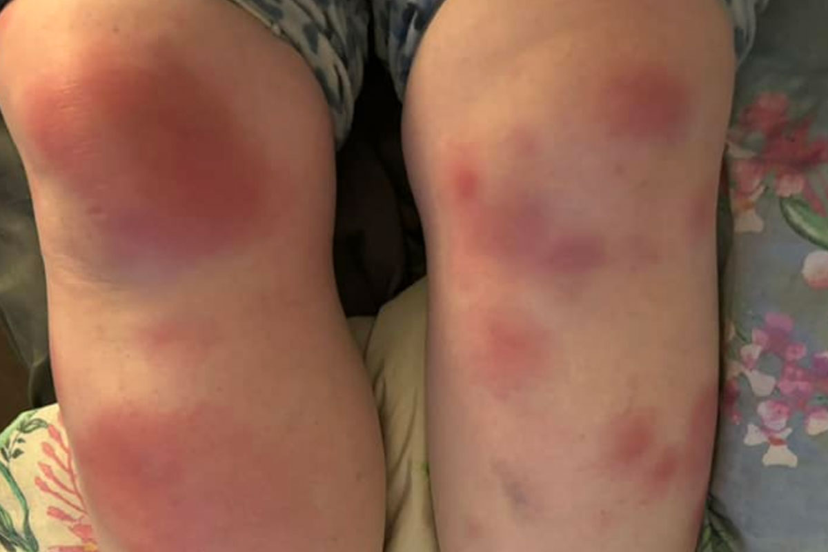 איך יודעים שיש פרעושים?